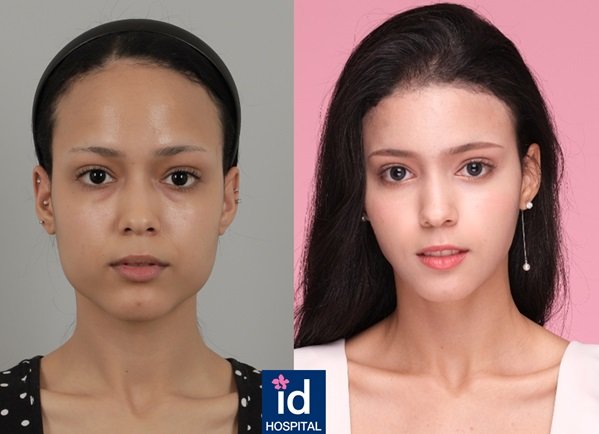 TOP 6 dramatic plastic surgery Korea before and after