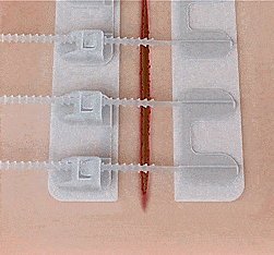 zipstitch-laceration-kit-lets-you-close-wounds-without-stitches-0.gif