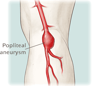 aneurysm-popliteal-294x275.gif
