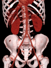 Volume_rendered_CT_scan_of_abdominal_and_pelvic_blood_vessels_(smaller) (1).gif