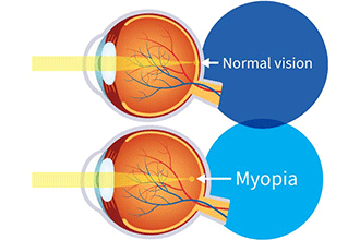 myopia-illustration-330x220.gif