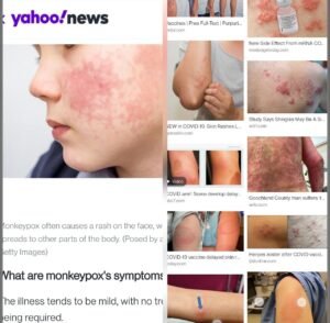 https://ourfreesociety.com/wp-content/uploads/2022/05/monkeypox-and-skin-reactions-to-death-jab-300x294.jpg