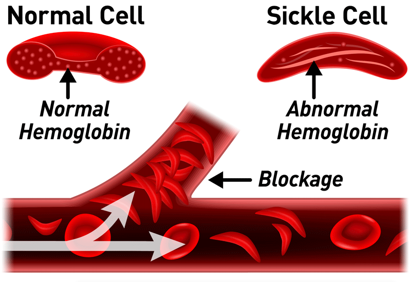 Sickle-Cell-Normal-Cell_800x549.gif