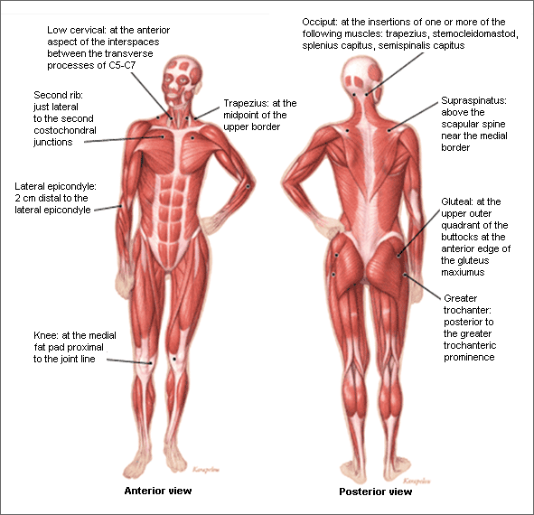 Schematic-ACR-Trigger-Points-Fibromyalgia.gif