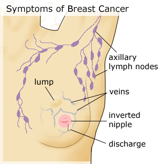 chanchalvali_1326028973_1-BreasrCancerSymptoms.gif