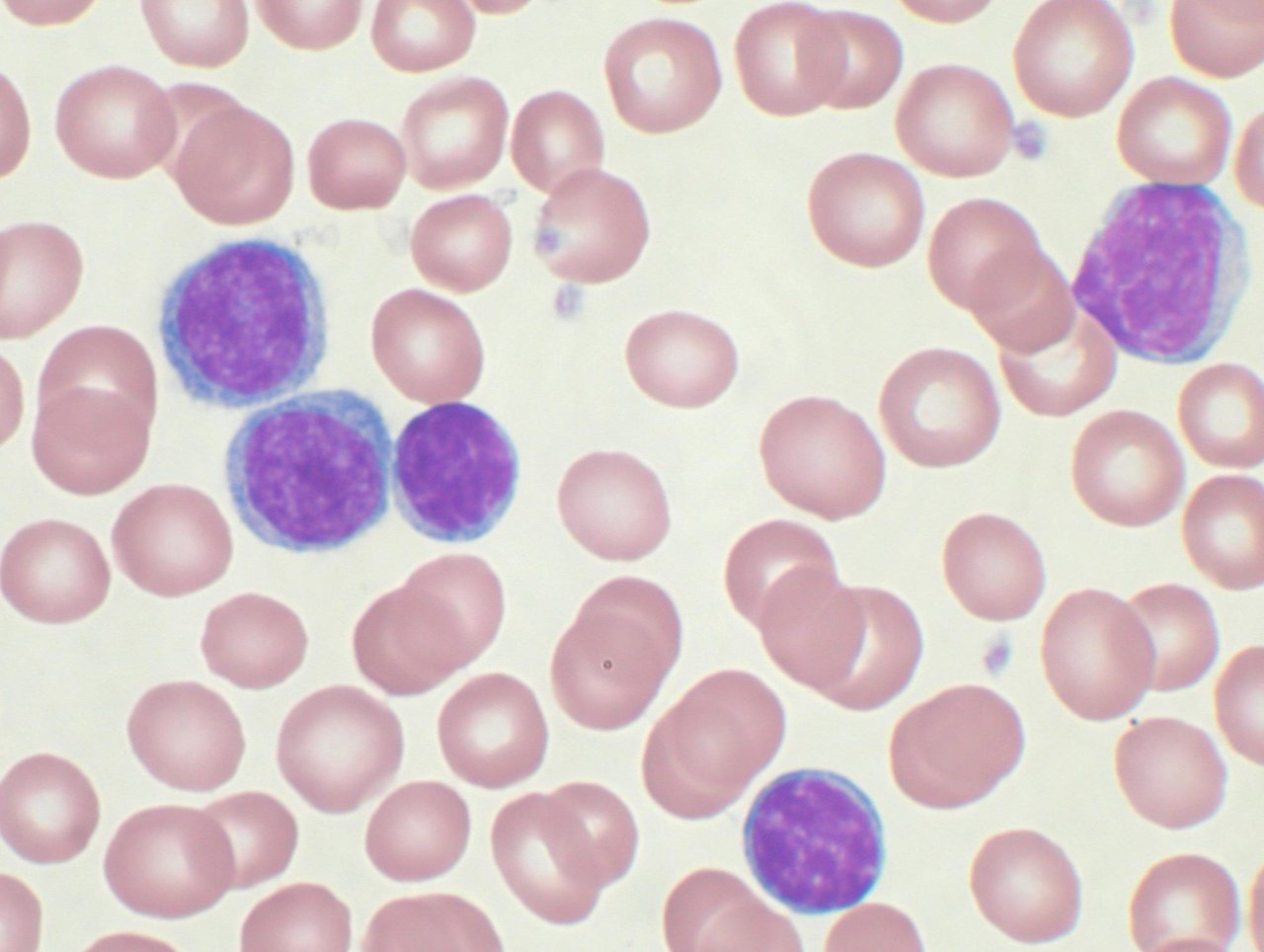https://upload.wikimedia.org/wikipedia/commons/0/0d/Chronic_lymphocytic_leukemia.jpg