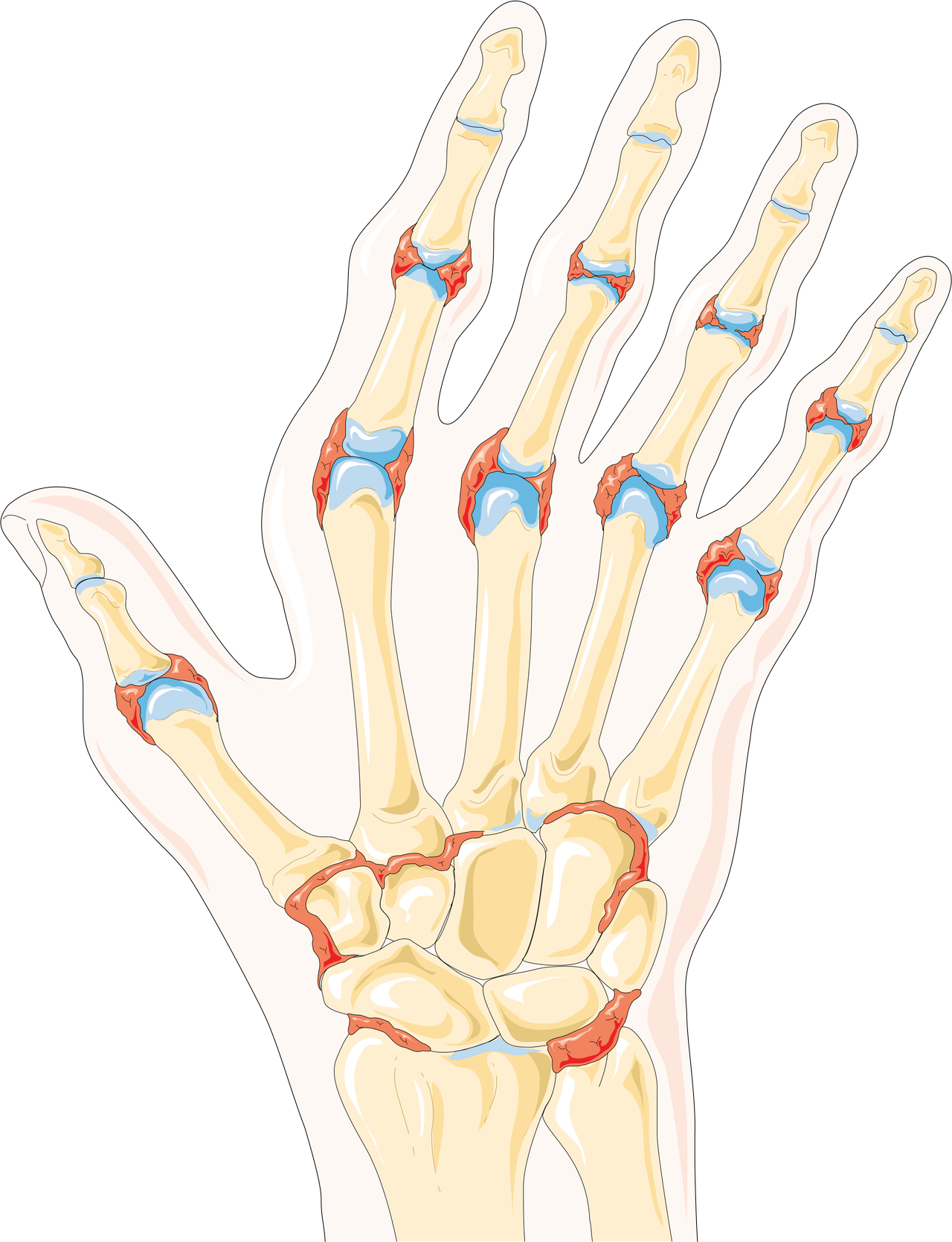 https://upload.wikimedia.org/wikipedia/commons/2/24/Rheumatoid_arthritis_1_--_Smart-Servier.png