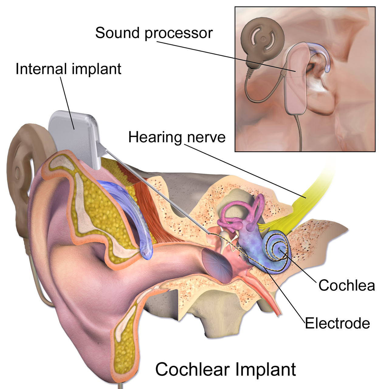 https://upload.wikimedia.org/wikipedia/commons/5/50/Blausen_0244_CochlearImplant_01.png