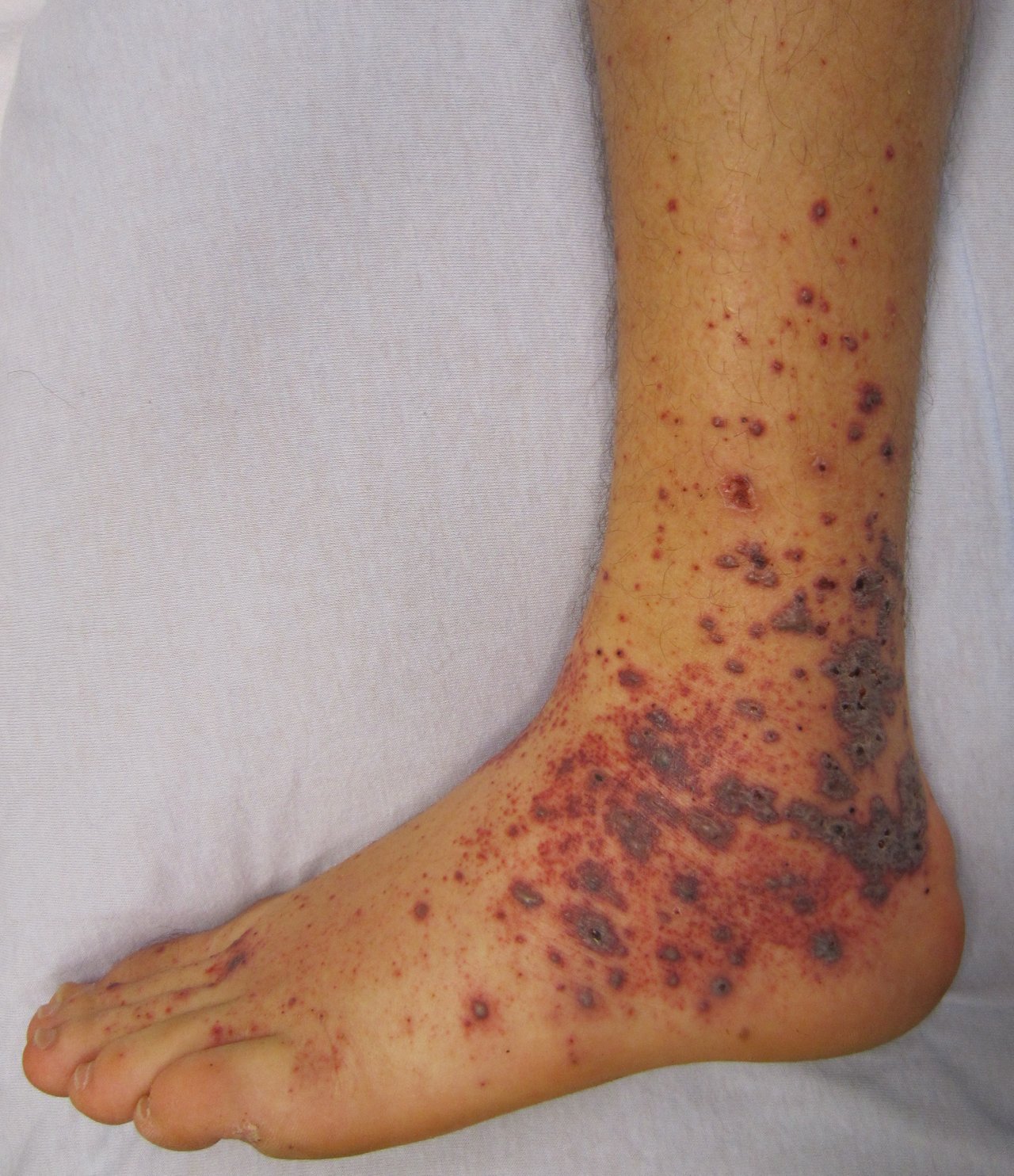 https://upload.wikimedia.org/wikipedia/commons/5/5e/Vasculitis.JPG