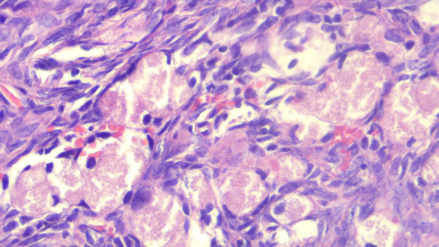 Krukenberg Tumors - Stemgeeks