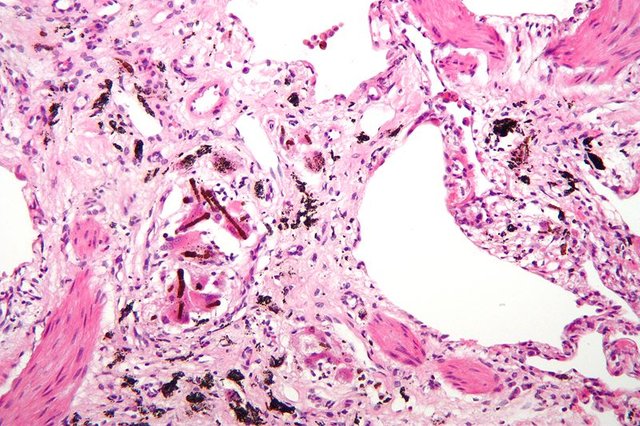 800px-Asbestosis_high_mag.jpg