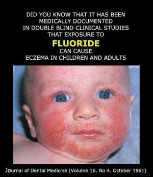 eczema and fluoride