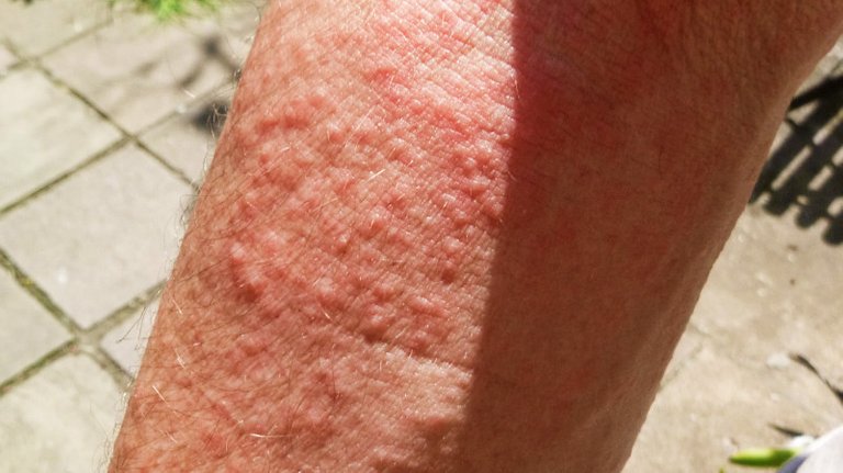 African Grass Rash