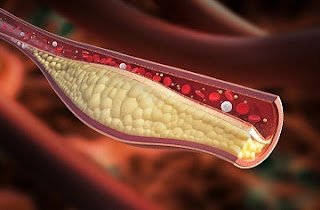 High cholesterol: Symptoms and causes