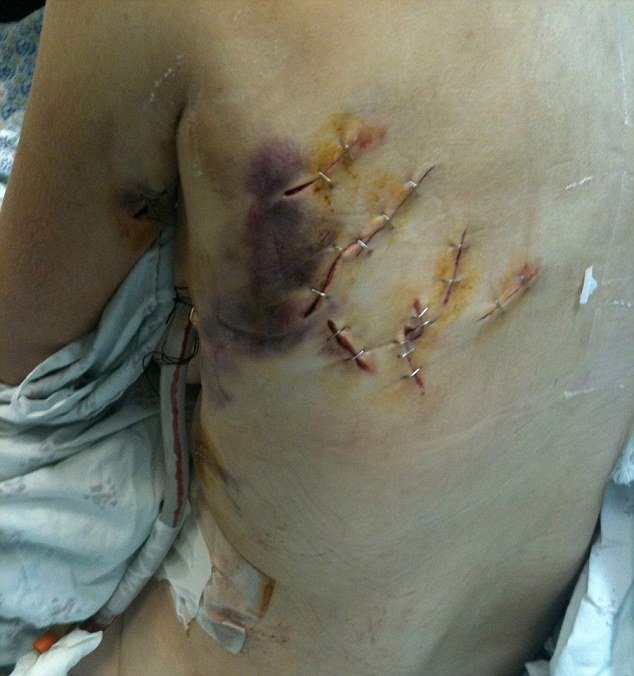 Wounds on the back of Kay Wilson following machete attack in 2010