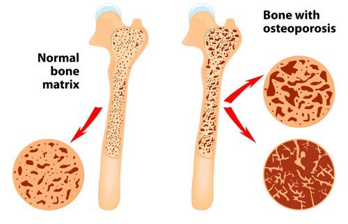 Osteoporosis risk factors in women
