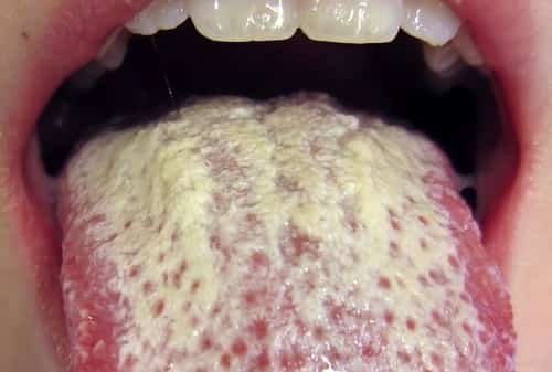 7_invasive-candidiasis.jpg