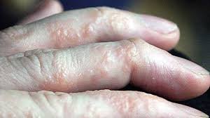 eczema1.jpg