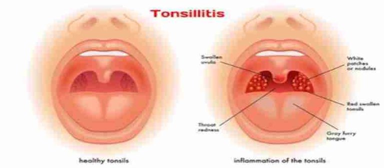 10-03-16-Tonsils_compressed.jpg