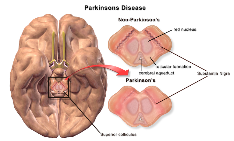 Blausen_0704_ParkinsonsDisease.png