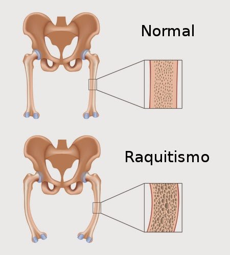 raquitismo.jpg