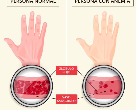 Anemia-ferropénica.png