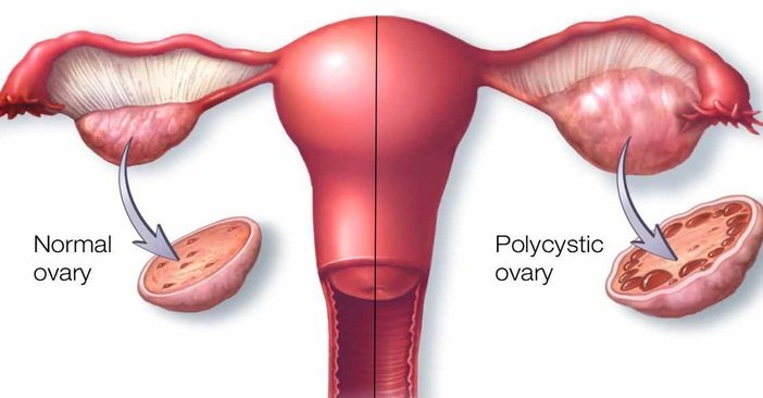 polycystic-ovary-syndrome-pcos_702x366.jpg