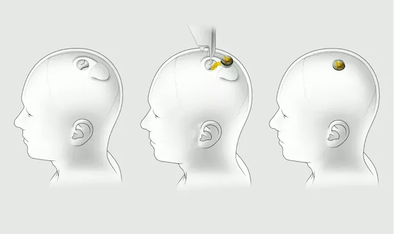 neuralink-installation.webp