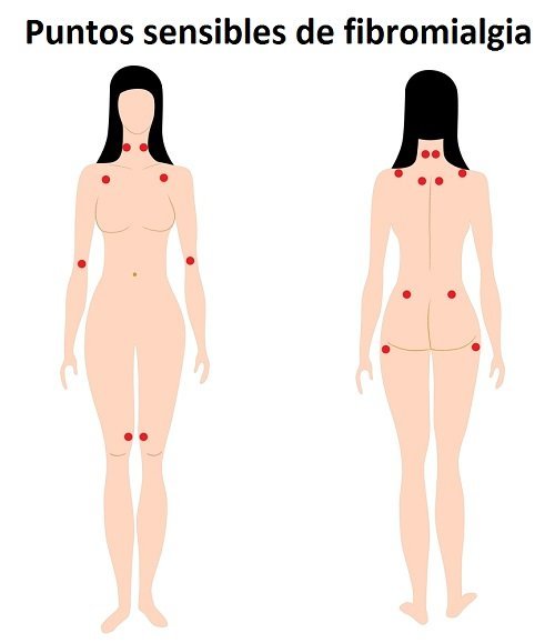 Fibromialgia (1).jpg