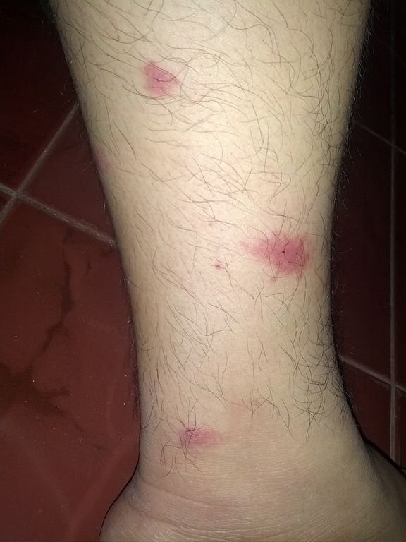 576px-Mosquito_bites_leg.jpg