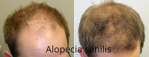 Minoxidil-antes-e-depois-2 (1).jpg