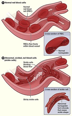 300px-Sickle_cell_01.jpg