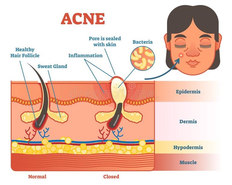 acne-diagram-illustration-hair-pimple-skin-layers-structure-female-face-alongside-educational-medical-informat-acne-107604241.jpg