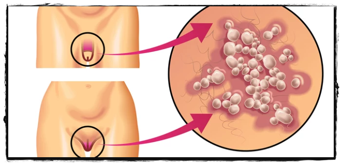 herpes genital pria dan wanita dapat di hilangkan diobati diatasi dengan QNC JELLY GAMAT secara TUNTAS ALAMI EFEKTIF OPTIMAL serta pastinya AMAN 1.png