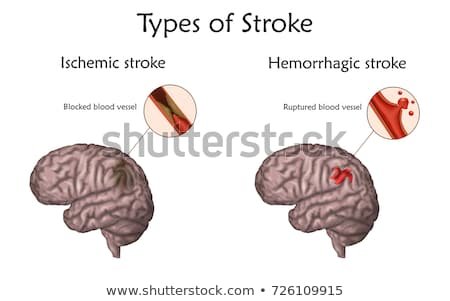 stroke-types-poster-banner-hemorrhagic-450w-726109915.jpg