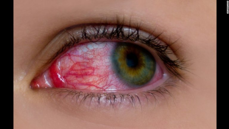 141216164003-pink-eye-stock-photo-horizontal-large-gallery.jpg