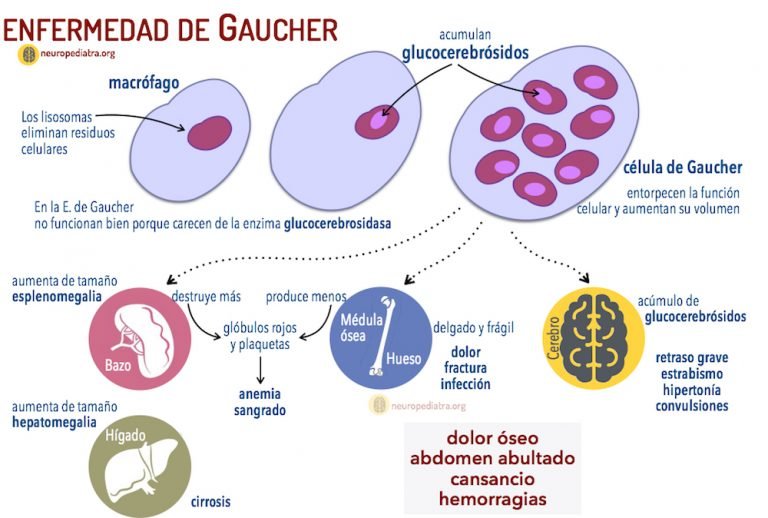 enfermedad-de-gaucher1-768x518.jpg