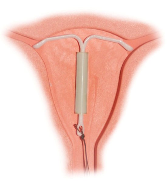 550px-Mirena_IntraUterine_System.jpg