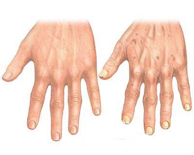 Hand_aging.jpg