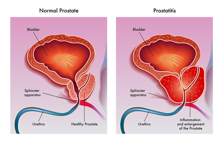 Prostatitis_1024x1024.jpg