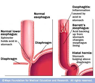 barretts-esophagus.jpg