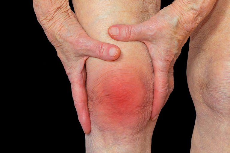 rheumatoid-arthritis-knee.jpg