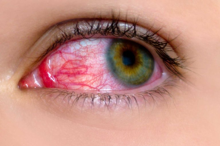 01-red-clear-signs-pink-eye-apichsn-25589704_MEDIUM.jpg