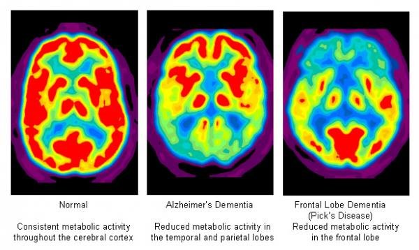 resizedimage600358-Brain.jpg