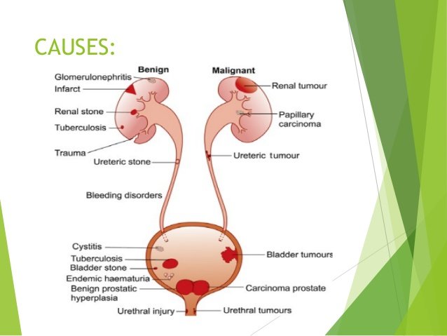 haematuria-10-638.jpg