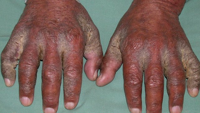 642x361_Scabies_SLIDE_5.jpg