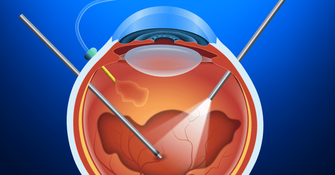 vitrectomy-1200x630.png