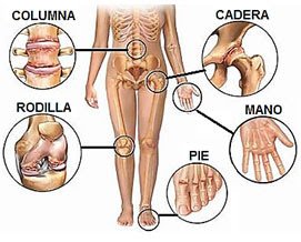 Artrosis-en-diferentes-partes-del-cuerpo.jpg