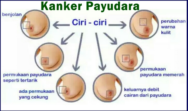 ciri-ciri-kanker-payduara.png