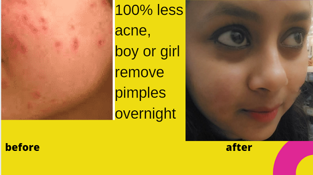 pimples removal tips.png